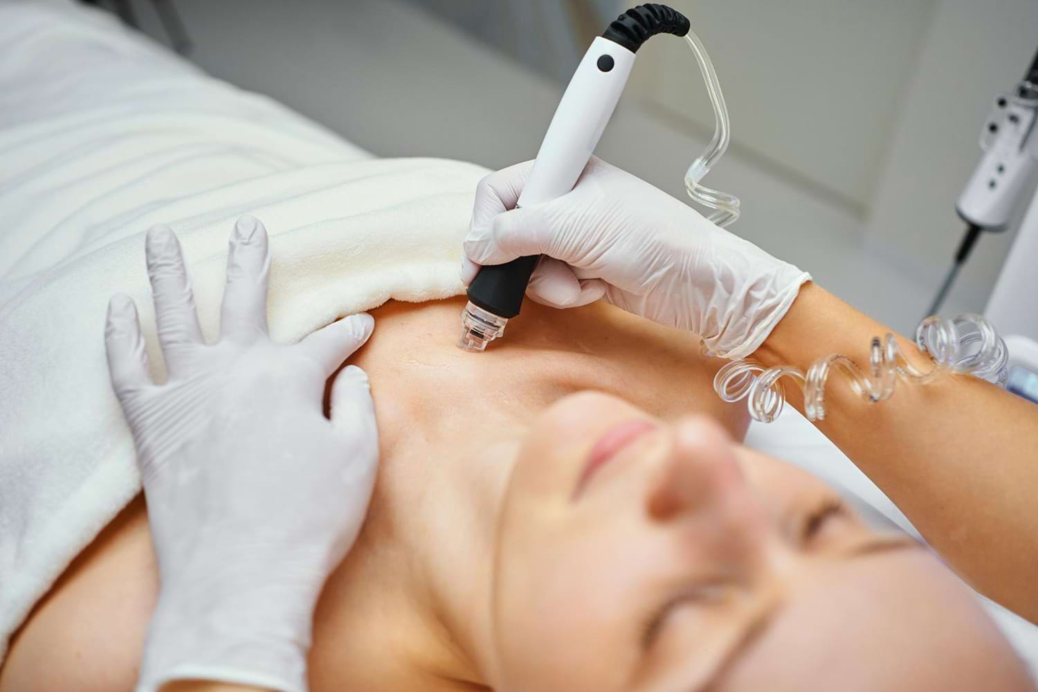 radiofrekwencja mikroigłowa