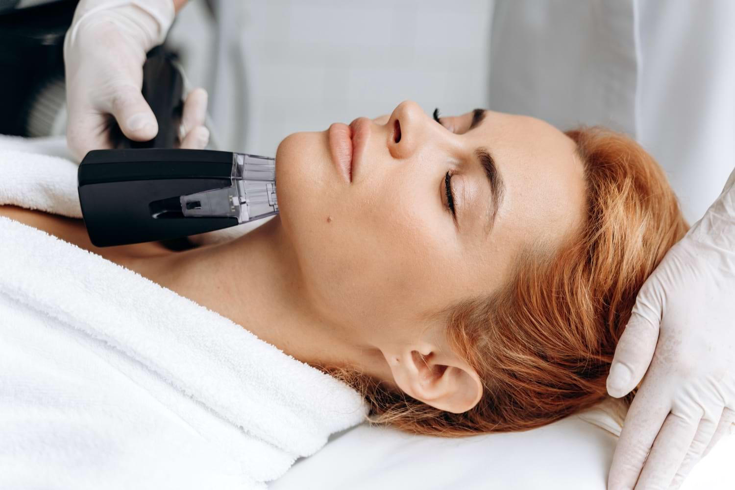 radiofrekwencja mikroigłowa